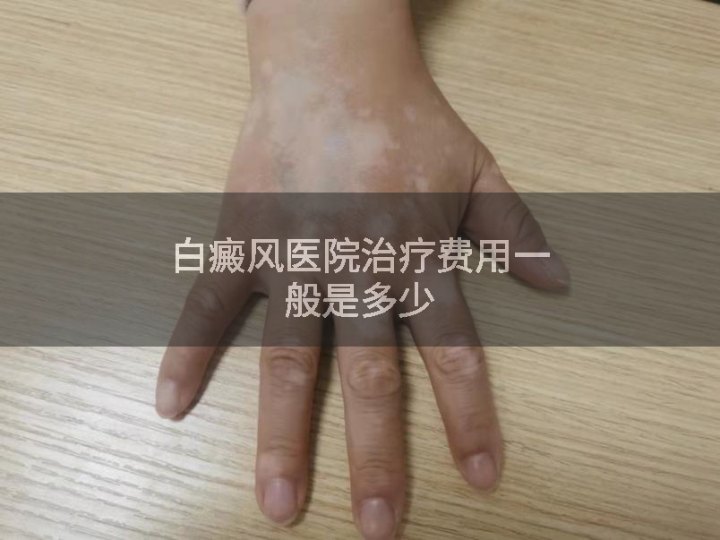 白癜风医院治疗费用一般是多少