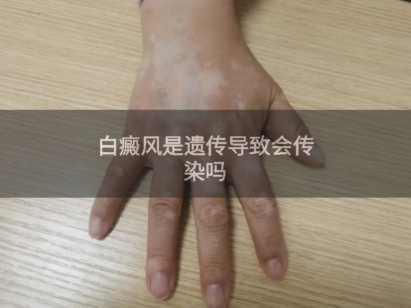 白癜风是遗传导致会传染吗