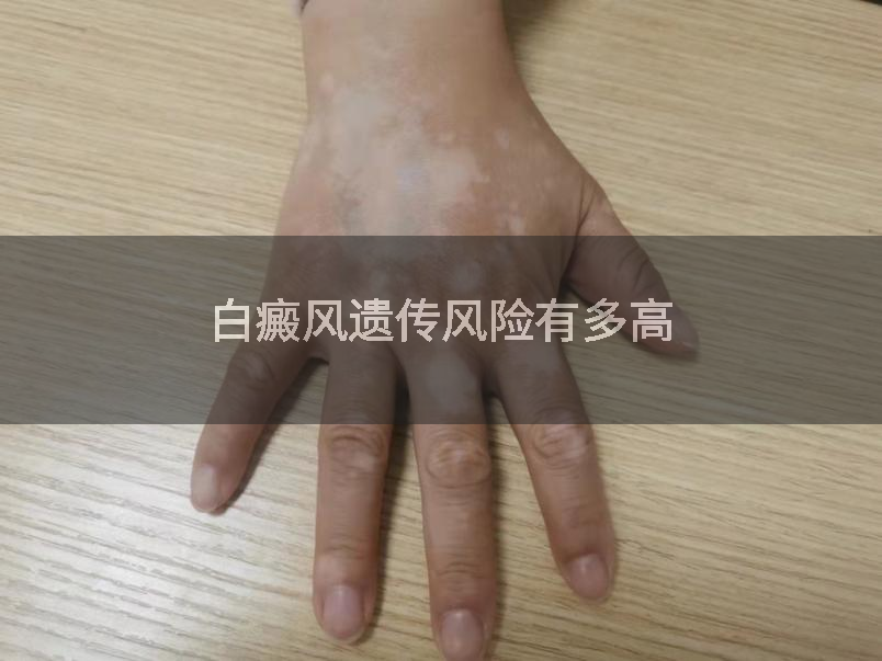 白癜风遗传风险有多高