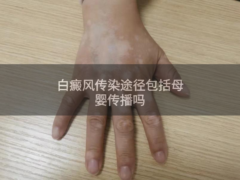 白癜风传染途径包括母婴传播吗