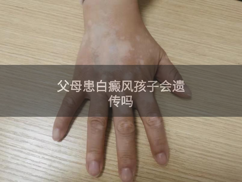 父母患白癜风孩子会遗传吗