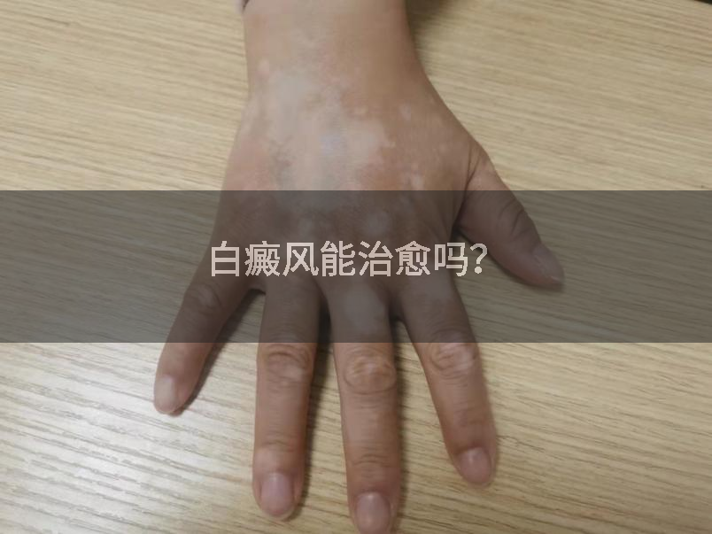 白癜风能治愈吗？