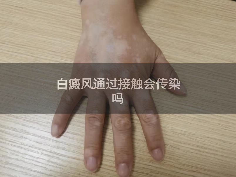 白癜风通过接触会传染吗