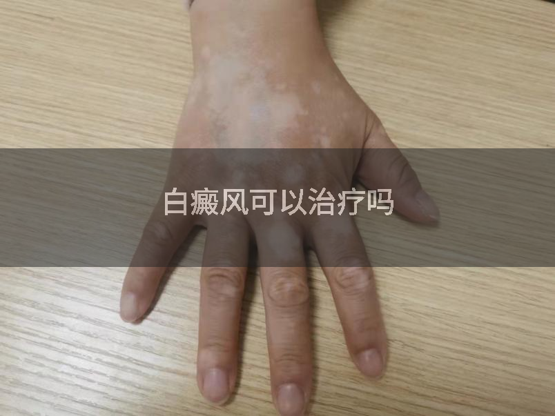白癜风可以治疗吗