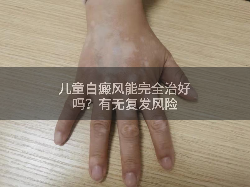 儿童白癜风能完全治好吗？有无复发风险