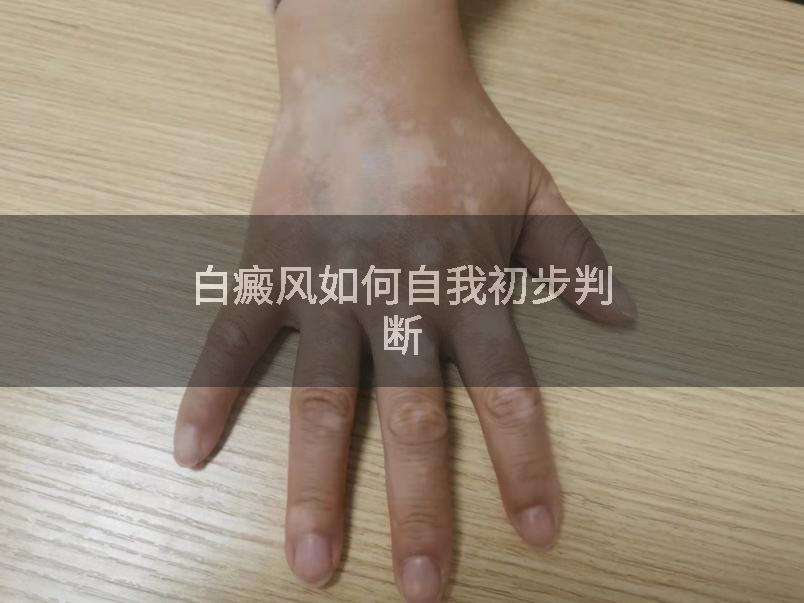 白癜风如何自我初步判断