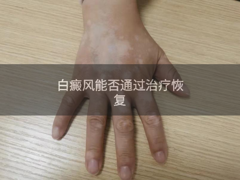 白癜风能否通过治疗恢复