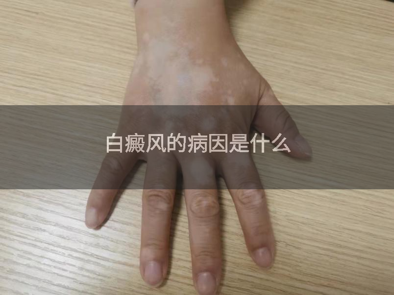 白癜风的病因是什么