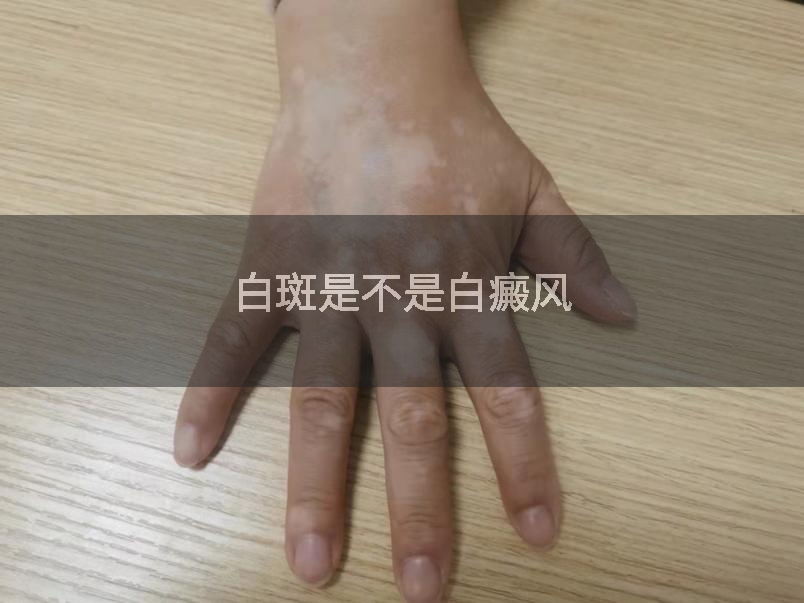 白斑是不是白癜风