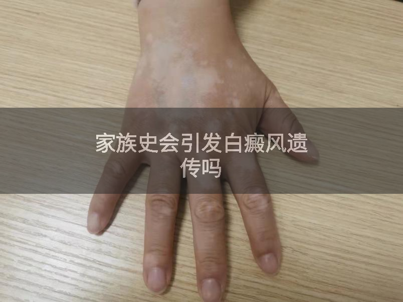 家族史会引发白癜风遗传吗