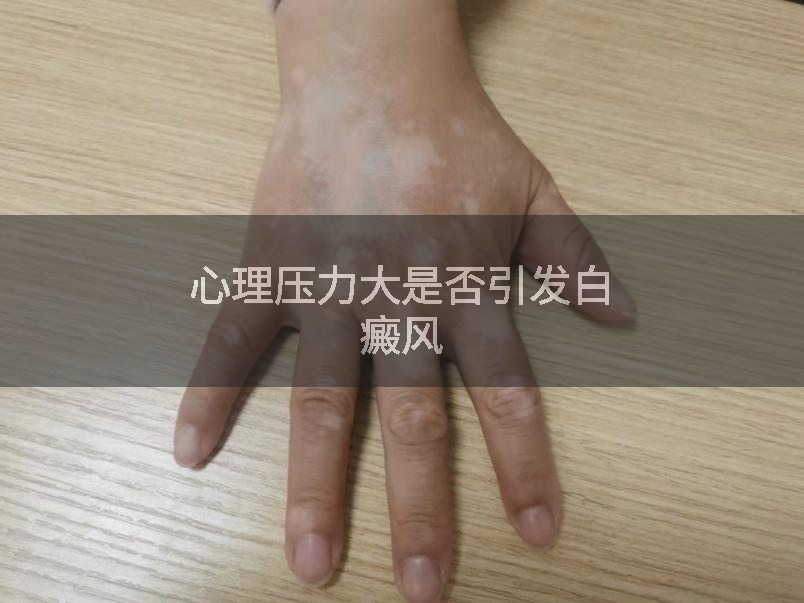 心理压力大是否引发白癜风