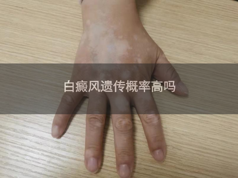 白癜风遗传概率高吗