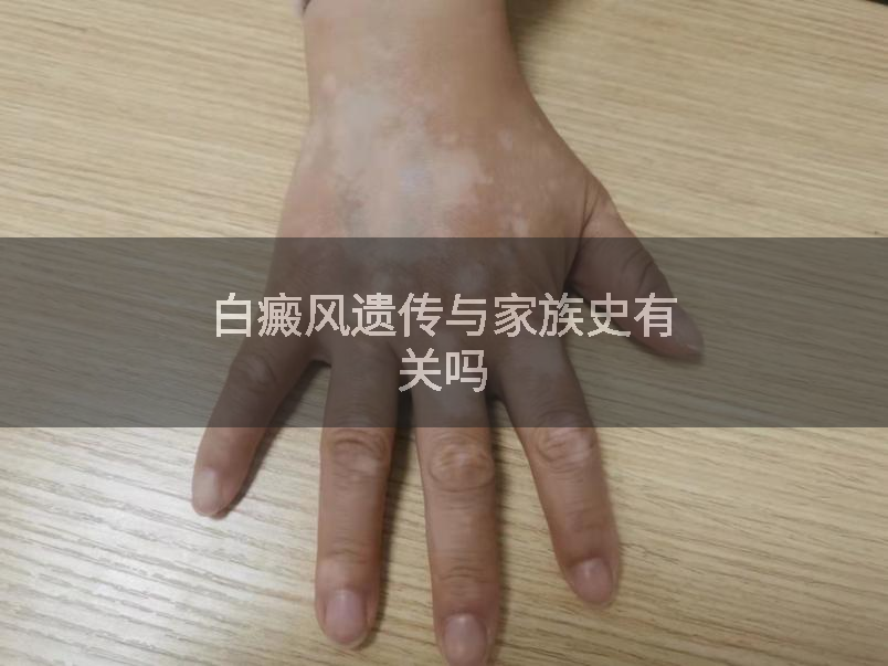 白癜风遗传与家族史有关吗