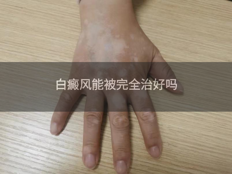 白癜风能被完全治好吗