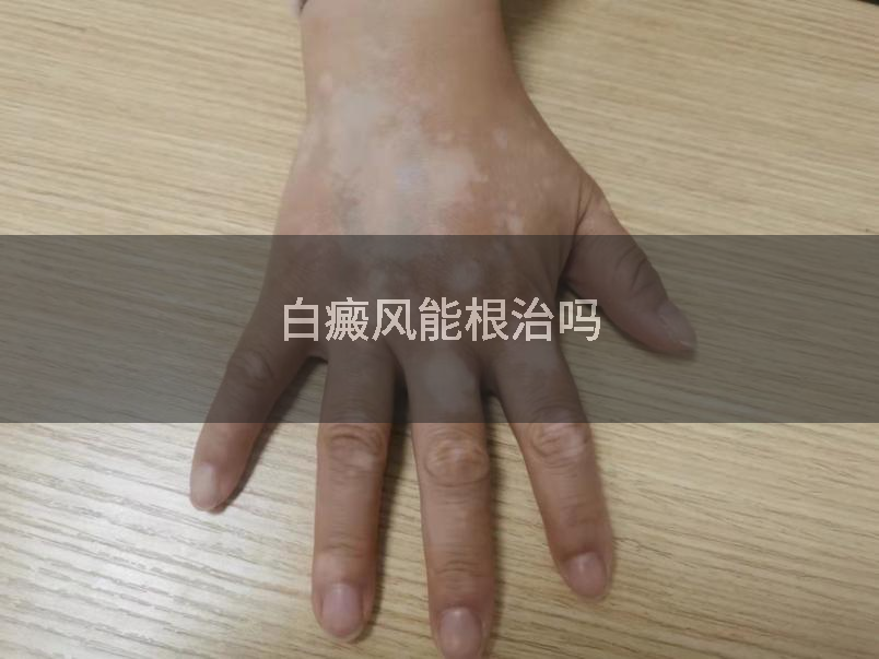 白癜风能根治吗