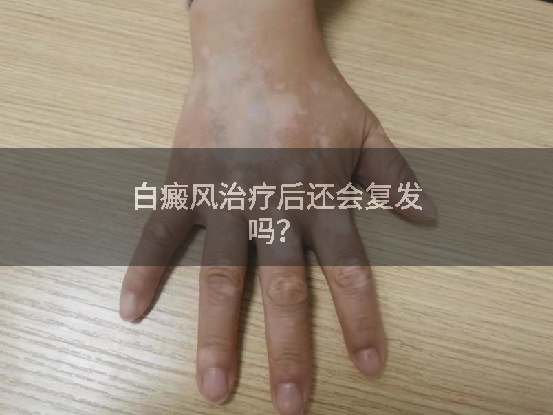 白癜风治疗后还会复发吗？
