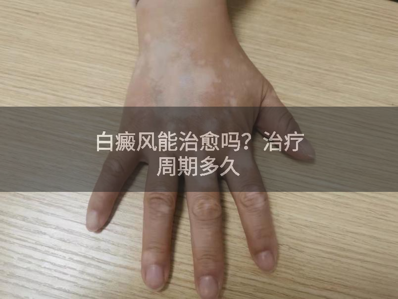 白癜风能治愈吗？治疗周期多久
