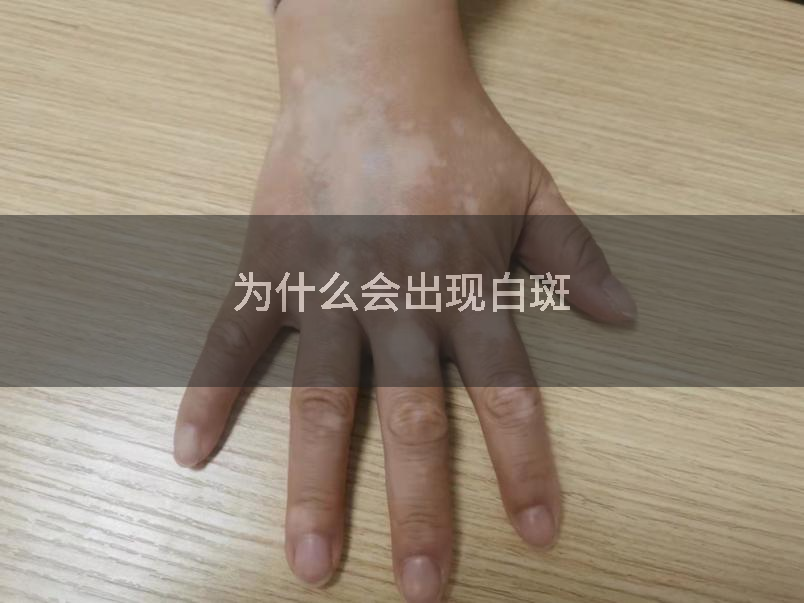 为什么会出现白斑