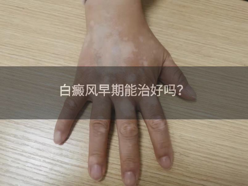 白癜风早期能治好吗？