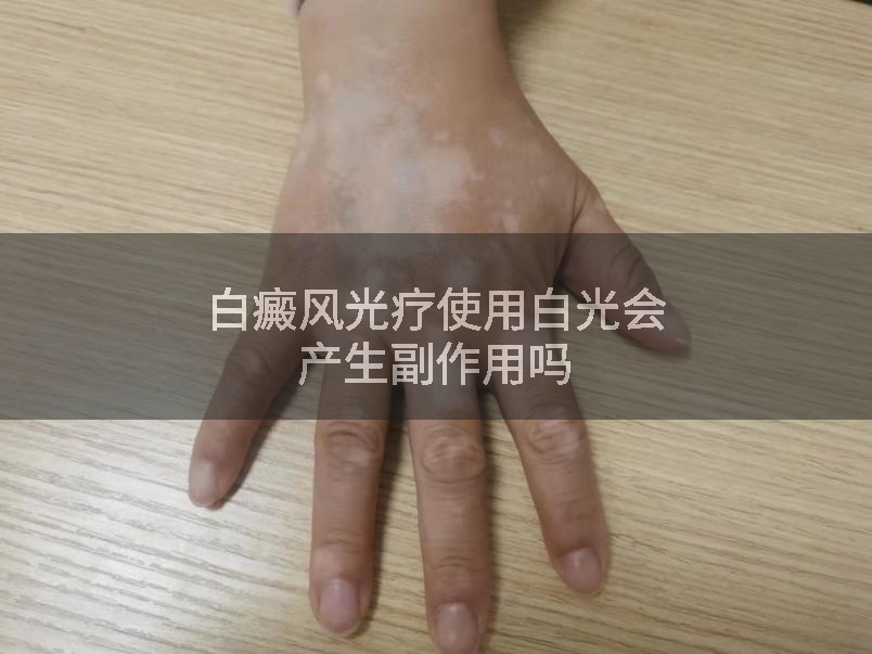 白癜风光疗使用白光会产生副作用吗
