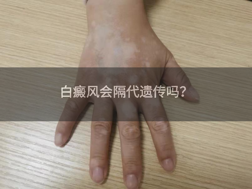 白癜风会隔代遗传吗?