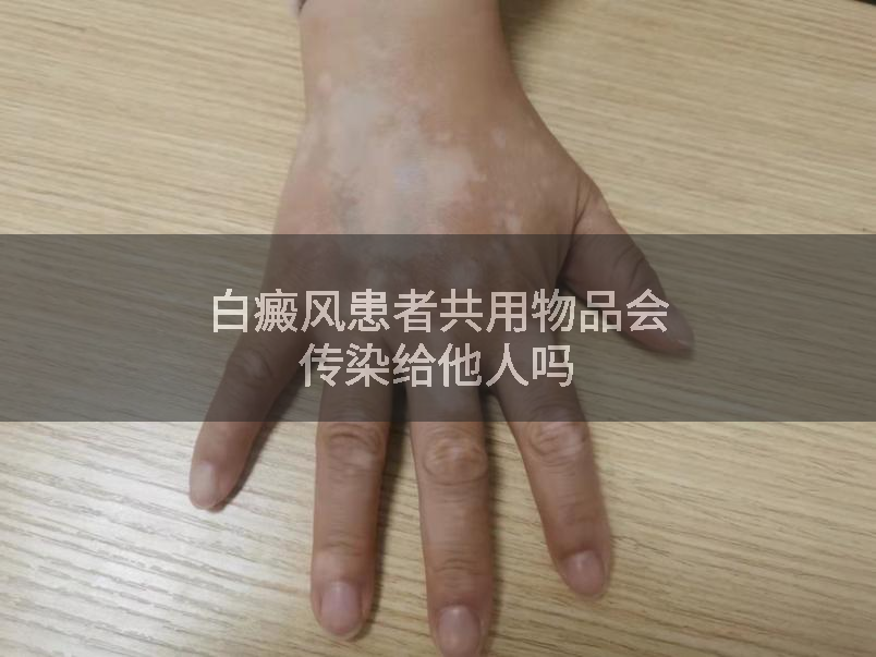 白癜风患者共用物品会传染给他人吗