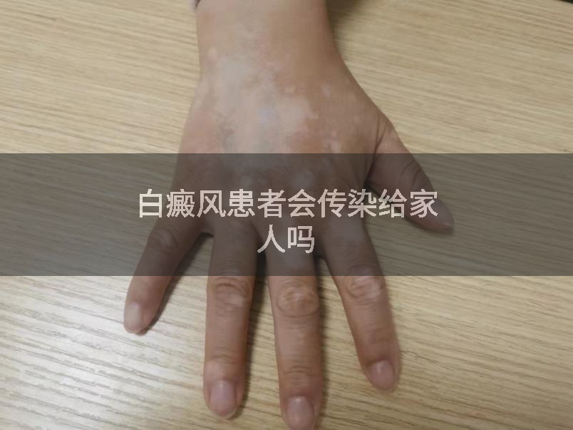白癜风患者会传染给家人吗