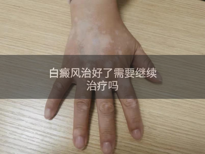白癜风治好了需要继续治疗吗