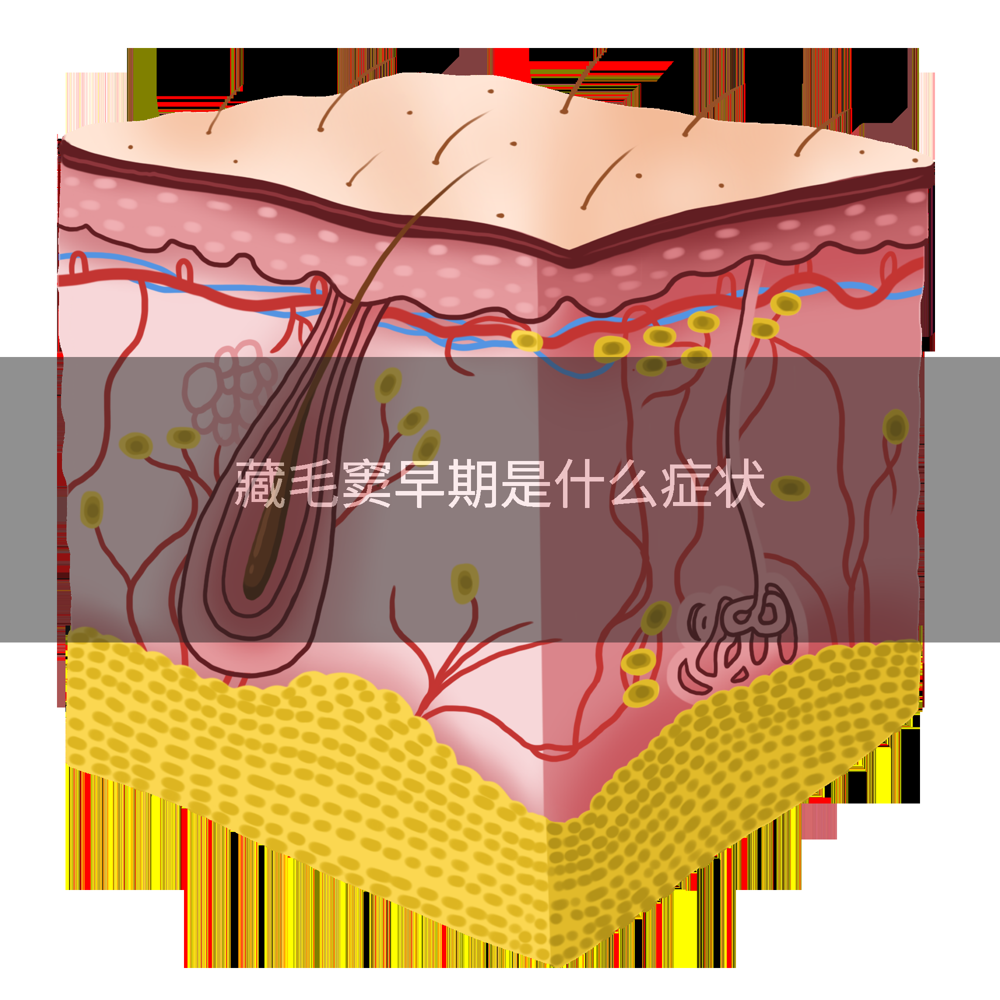 藏毛窦早期是什么症状