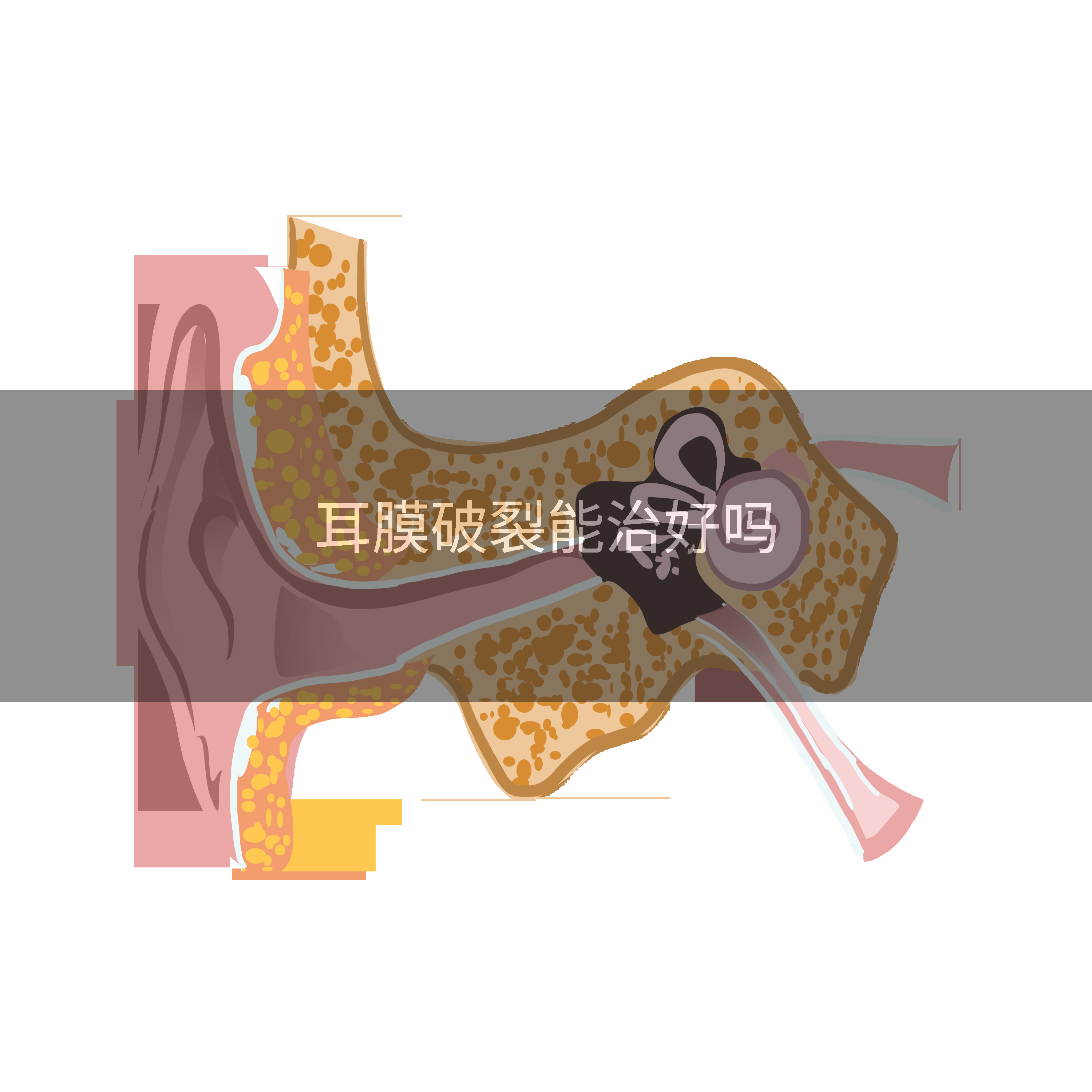 耳膜破裂能治好吗
