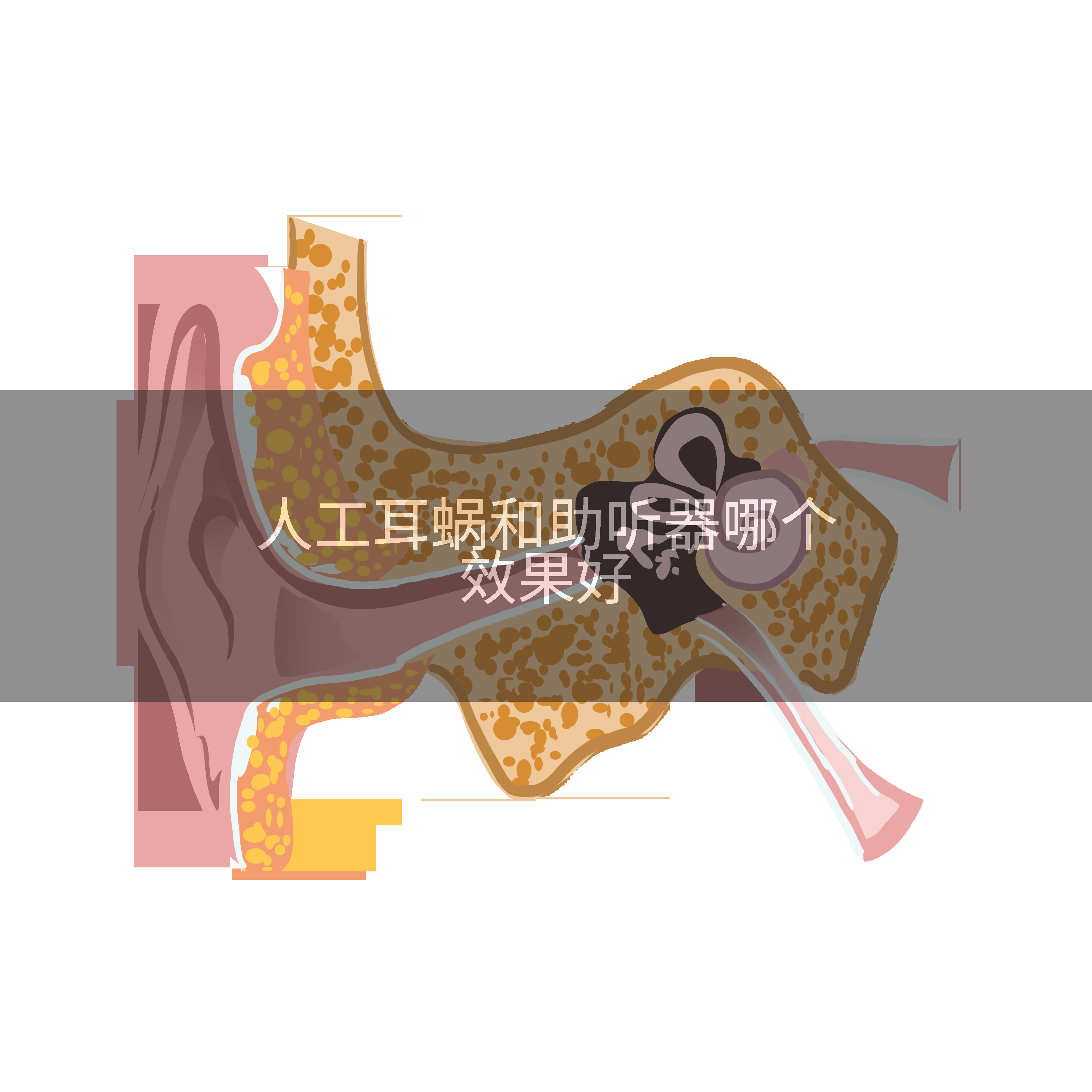 人工耳蜗和助听器哪个效果好