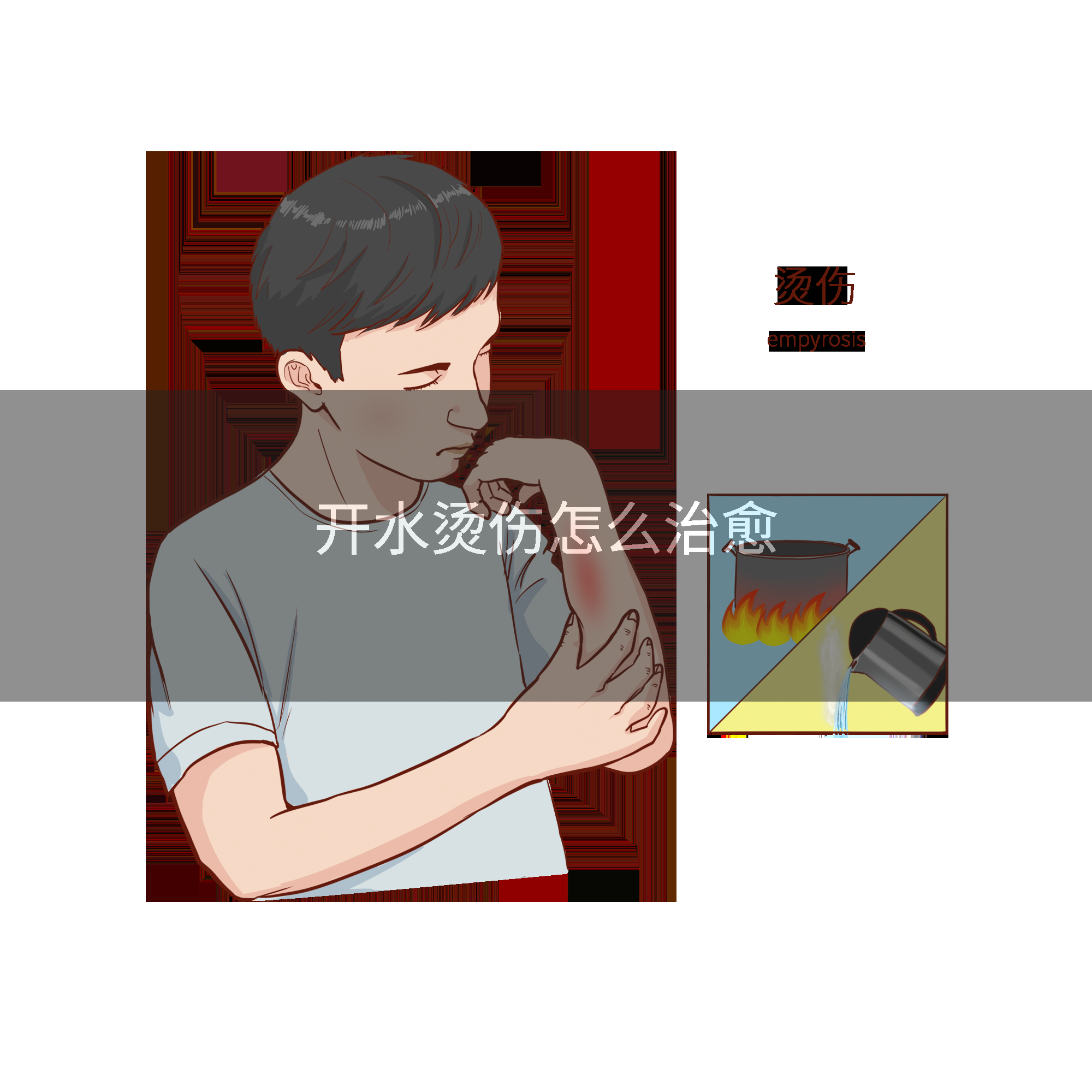 开水烫伤怎么治愈