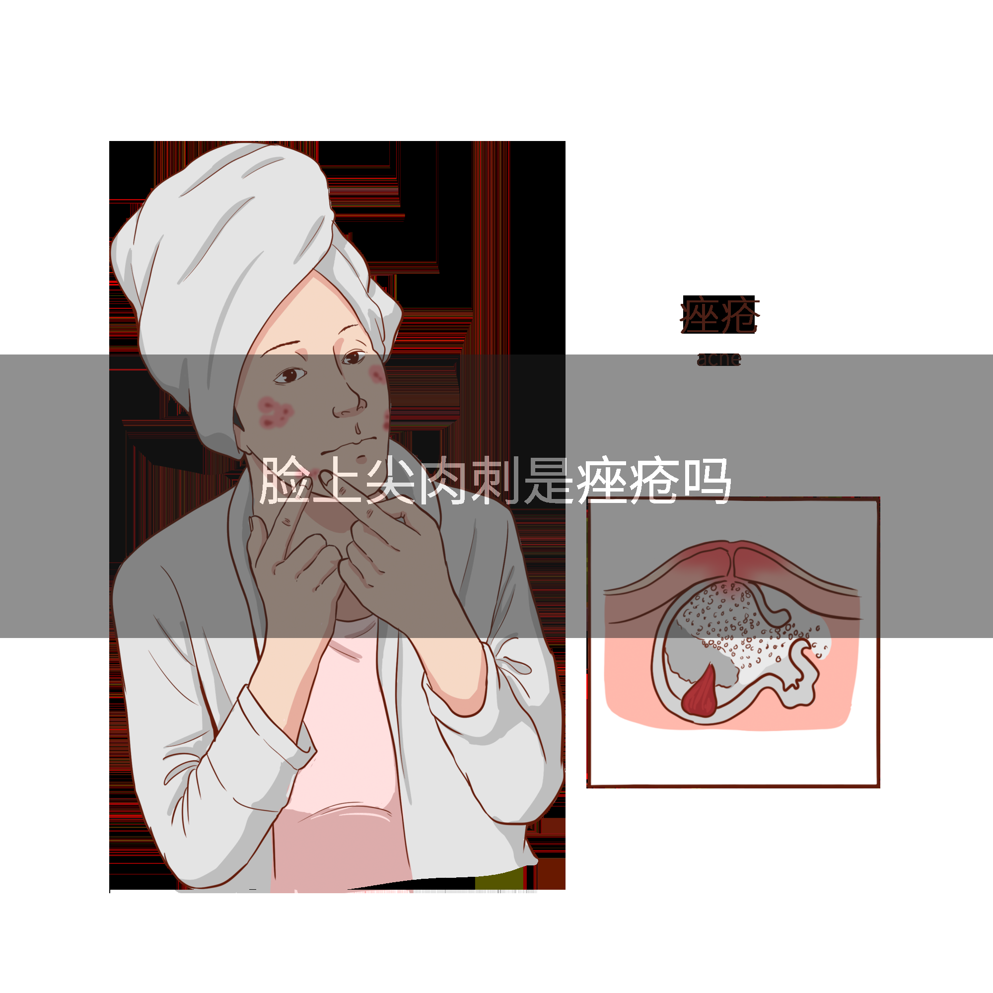 脸上尖肉刺是痤疮吗