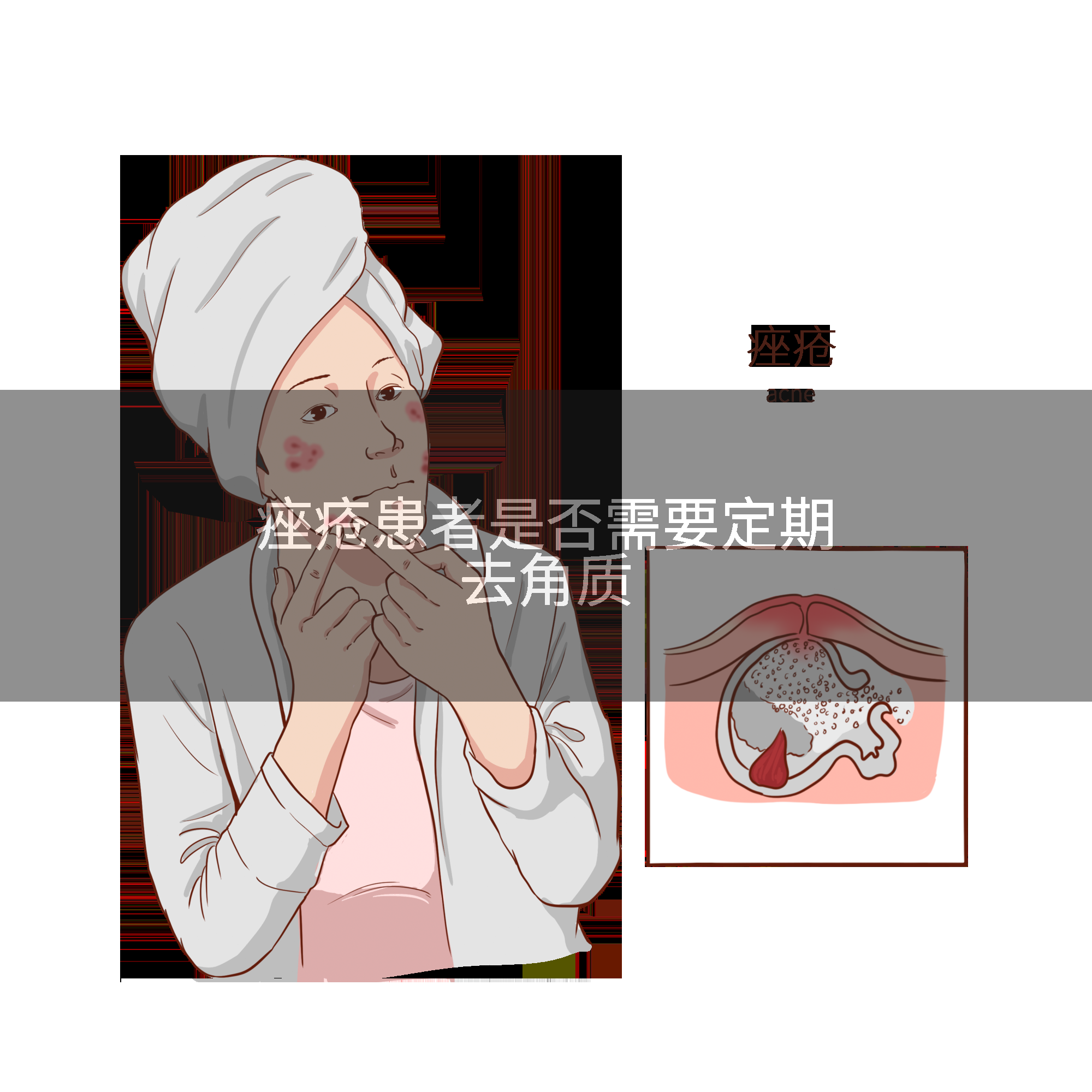 痤疮患者是否需要定期去角质