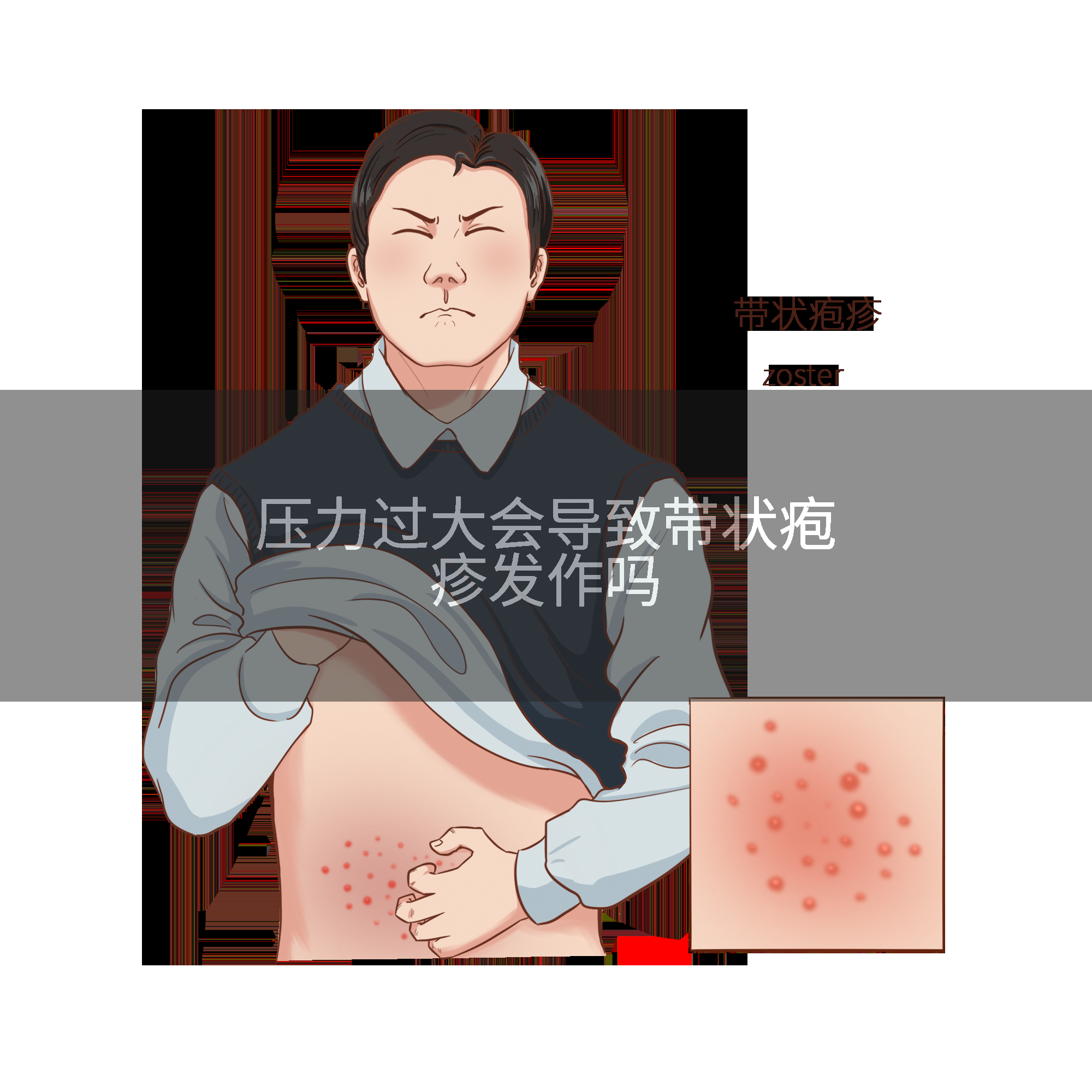 压力过大会导致带状疱疹发作吗