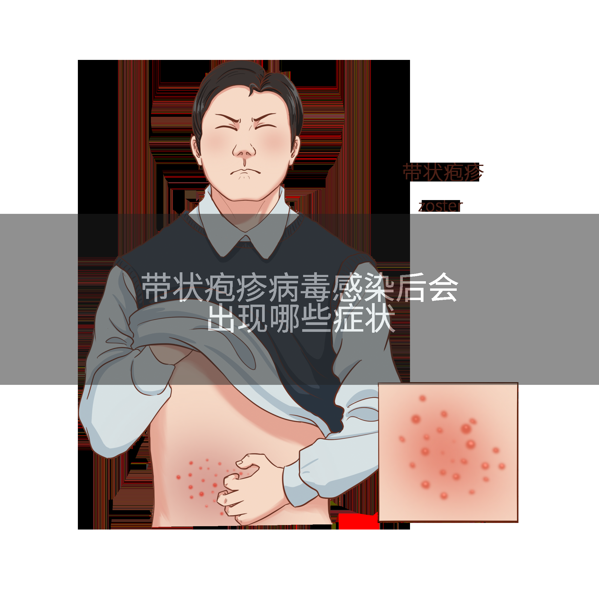 带状疱疹病毒感染后会出现哪些症状