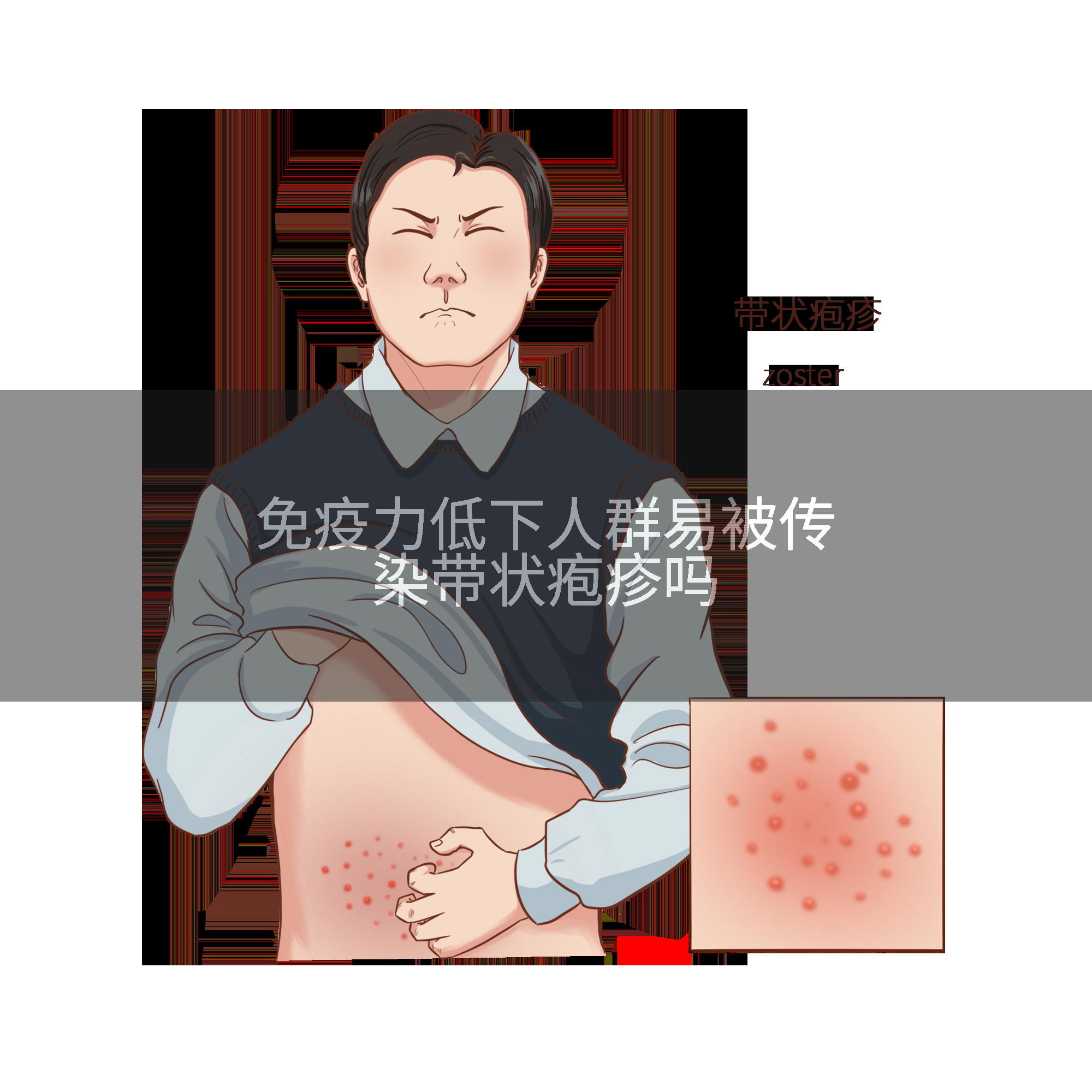 免疫力低下人群易被传染带状疱疹吗