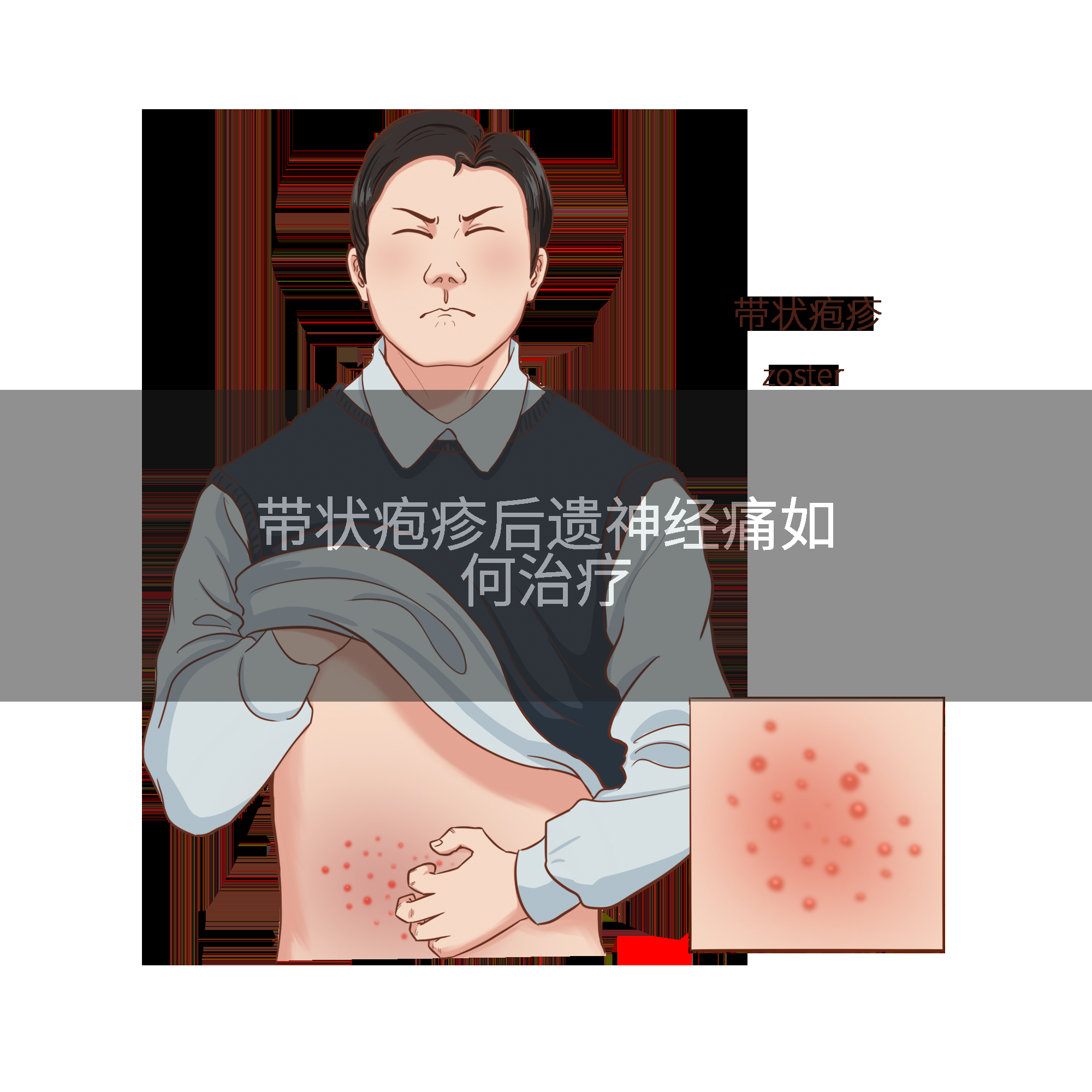 带状疱疹后遗神经痛如何治疗