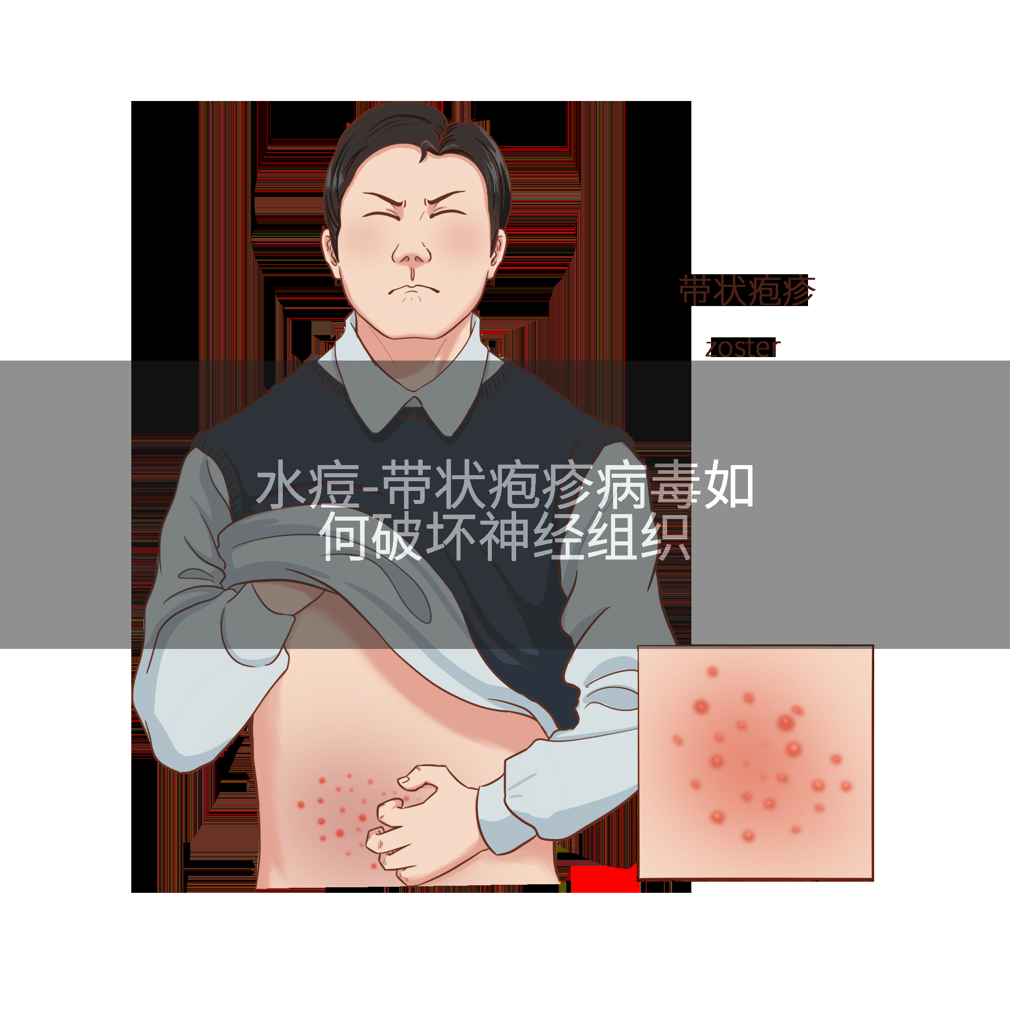 水痘-带状疱疹病毒如何破坏神经组织
