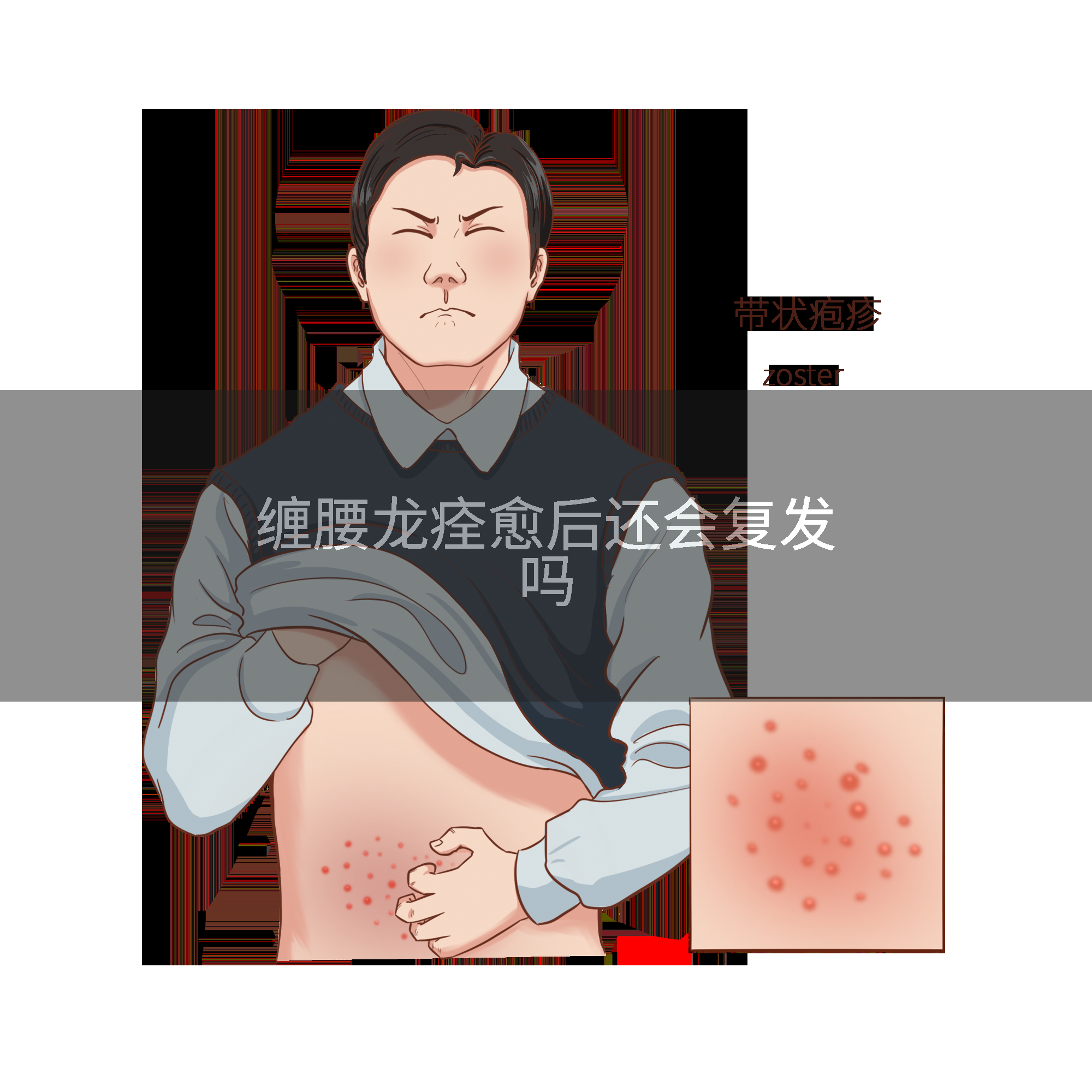 缠腰龙痊愈后还会复发吗