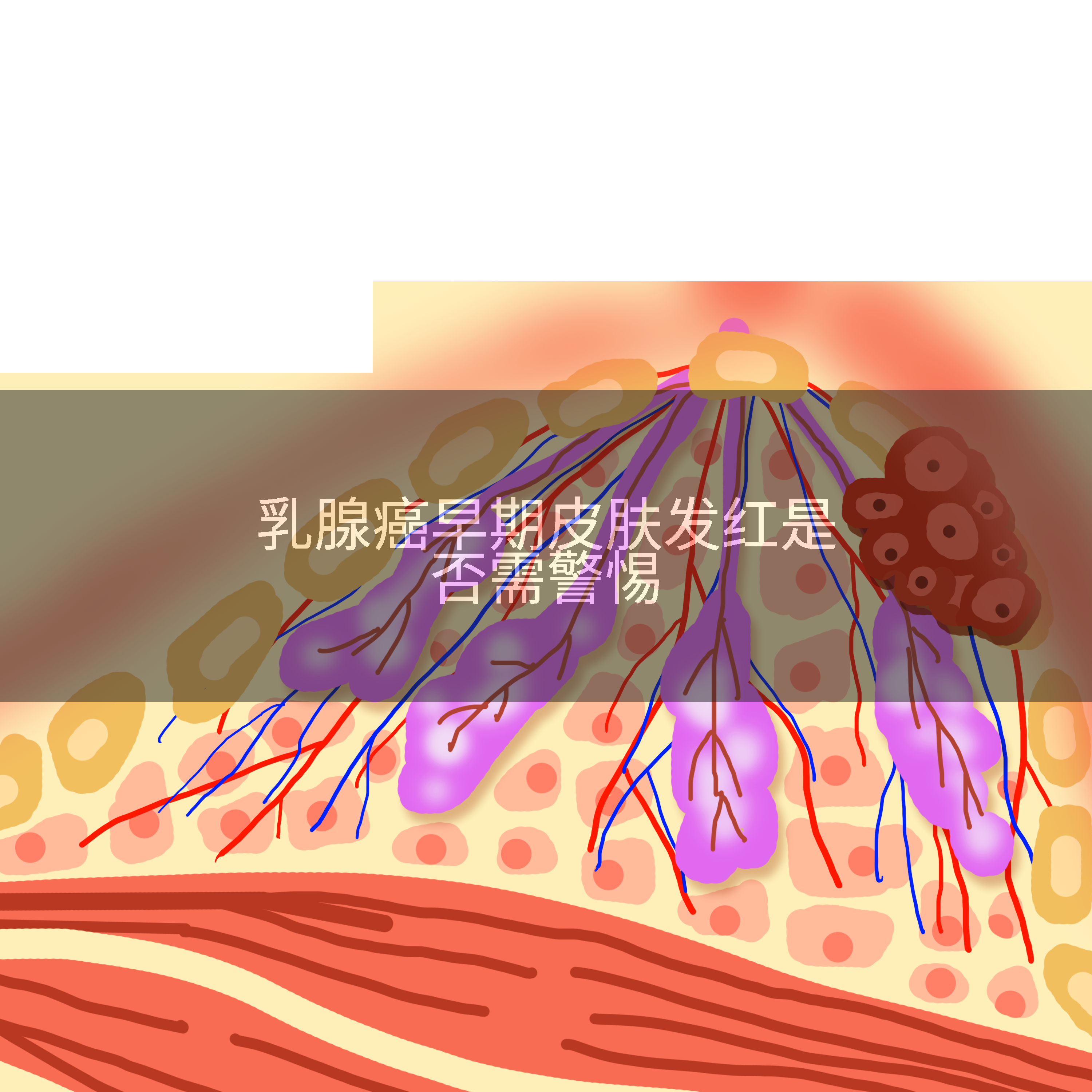 乳腺癌早期皮肤发红是否需警惕