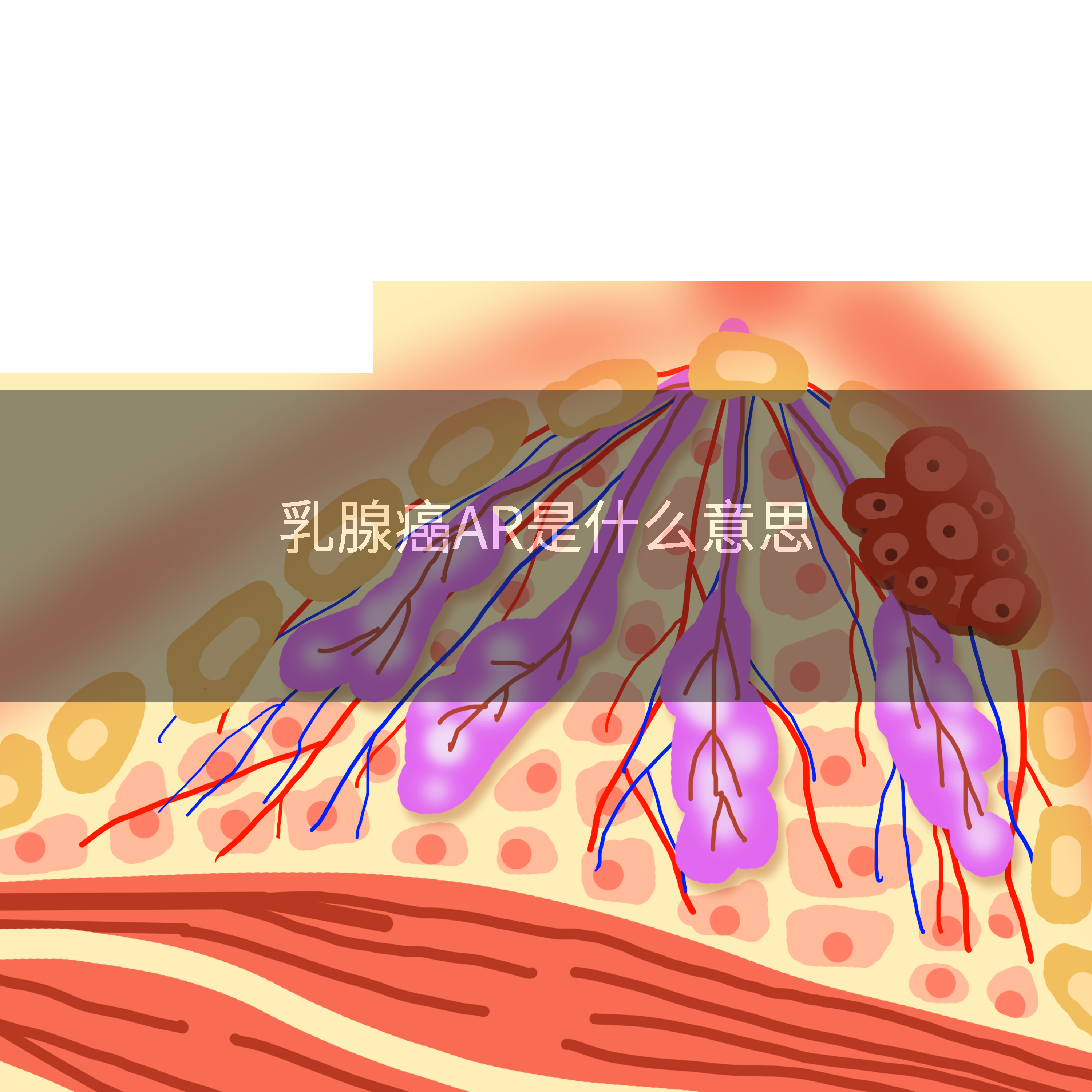 乳腺癌AR是什么意思