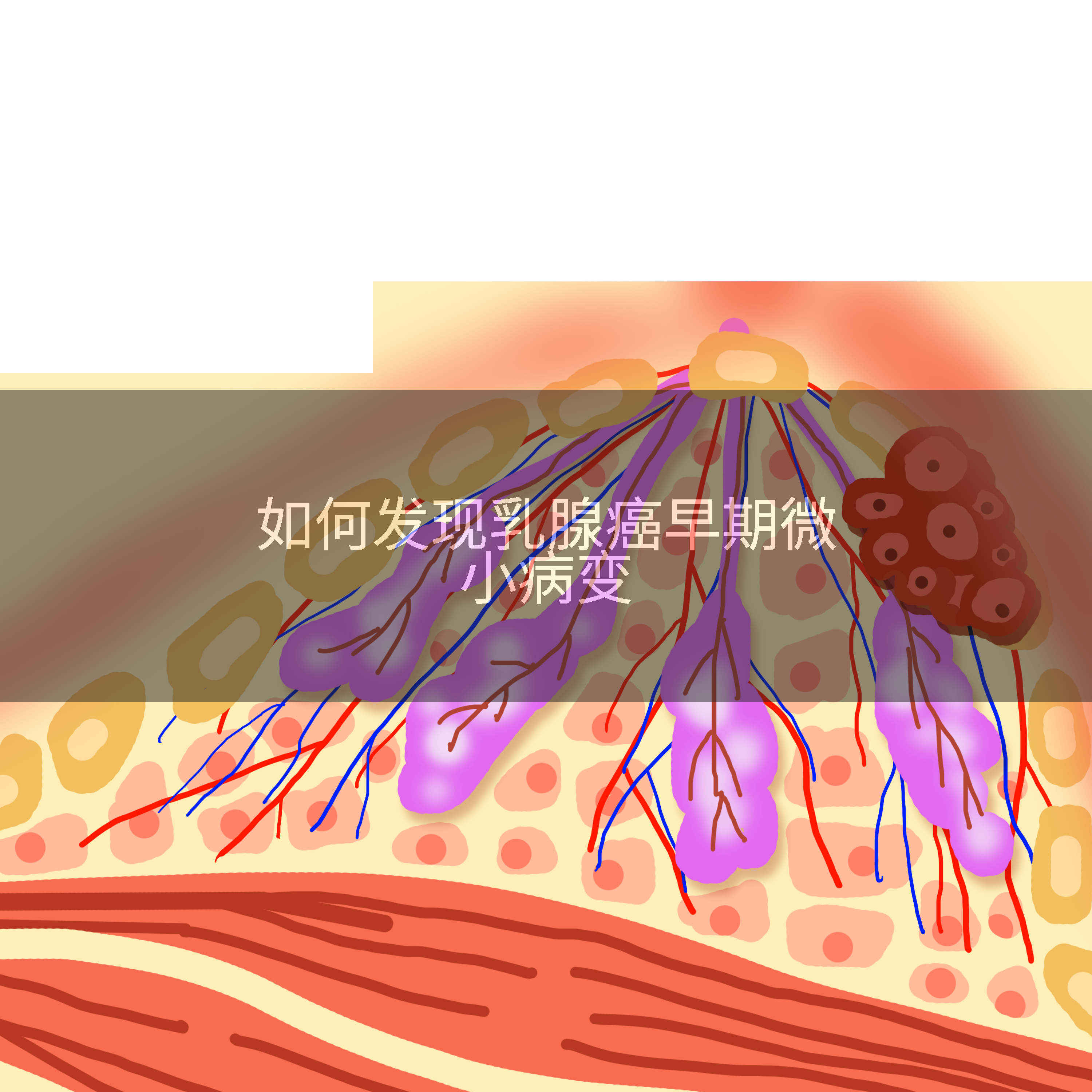 如何发现乳腺癌早期微小病变