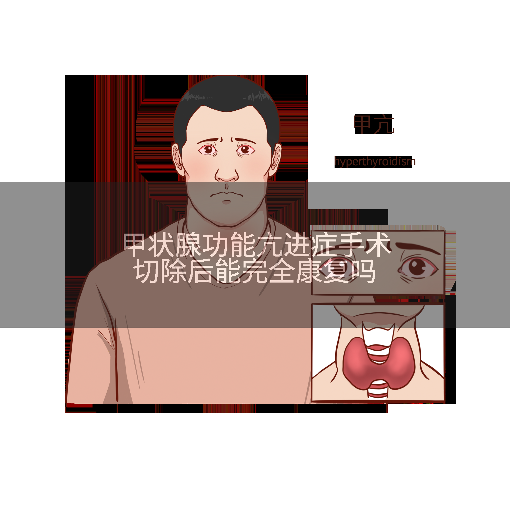 甲状腺功能亢进症手术切除后能完全康复吗