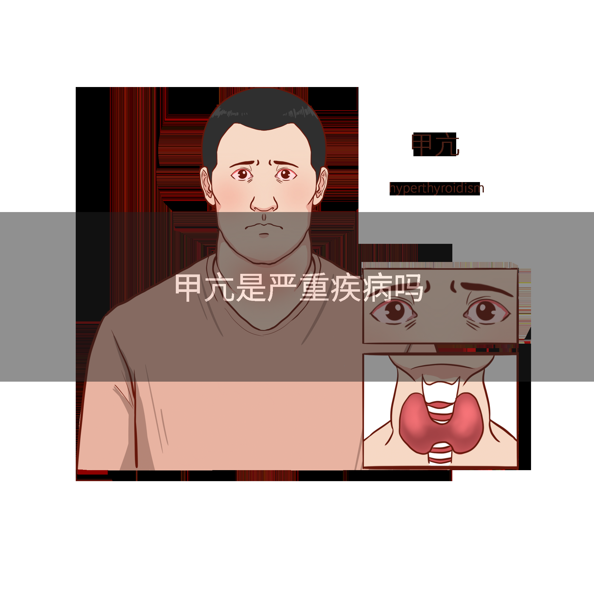 甲亢是严重疾病吗