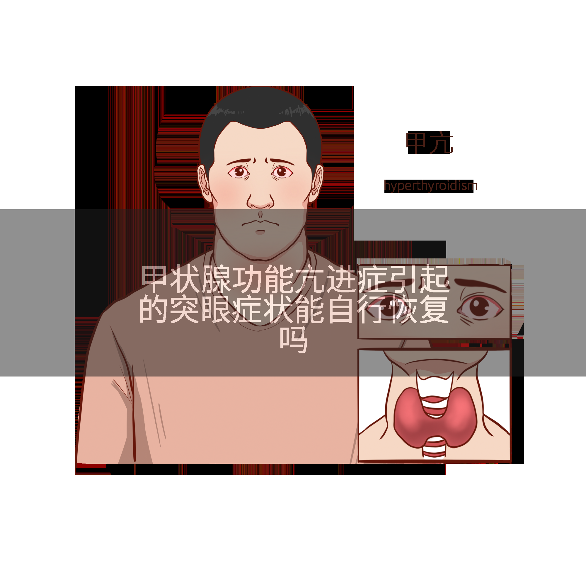 甲状腺功能亢进症引起的突眼症状能自行恢复吗