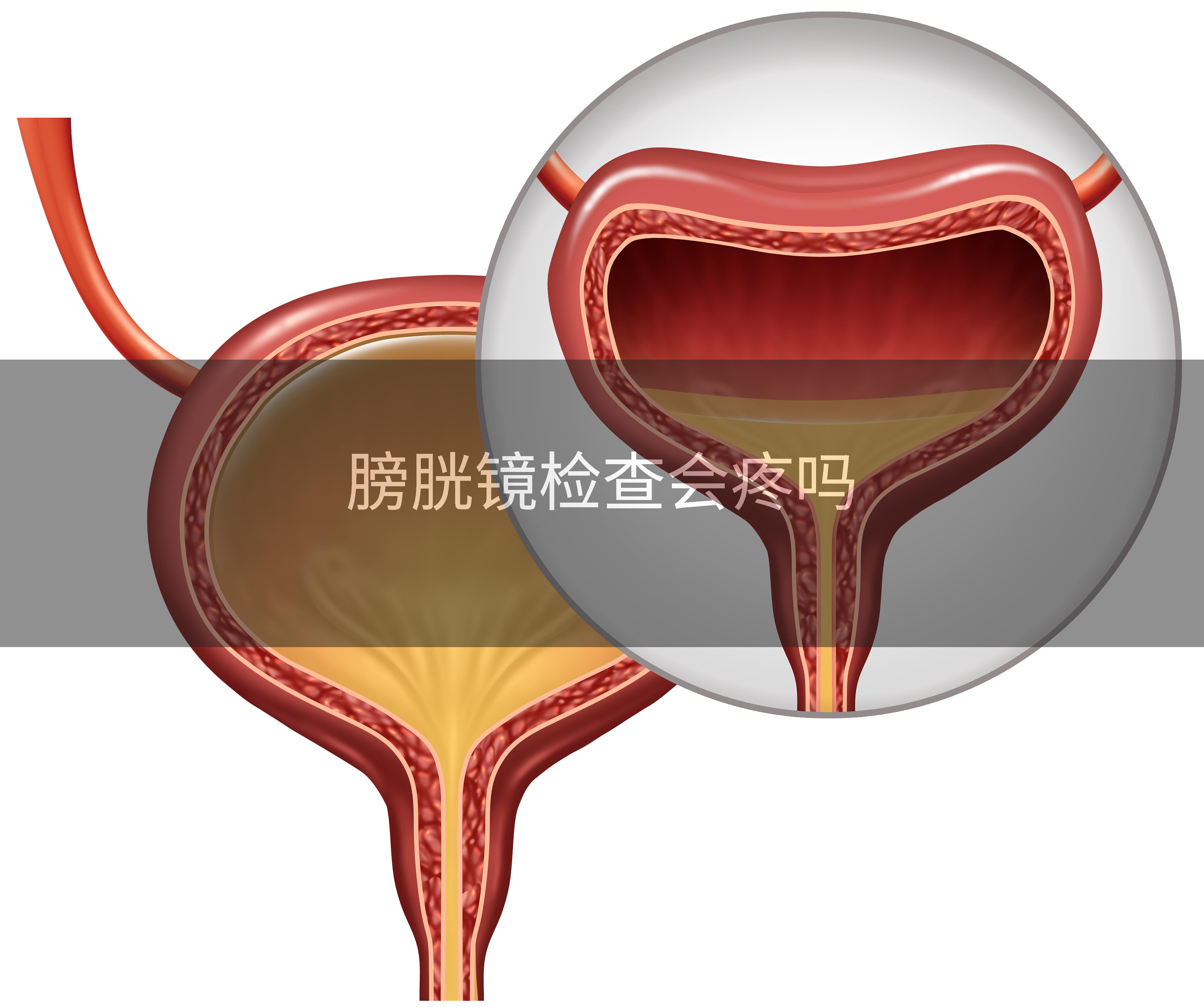 膀胱镜检查会疼吗