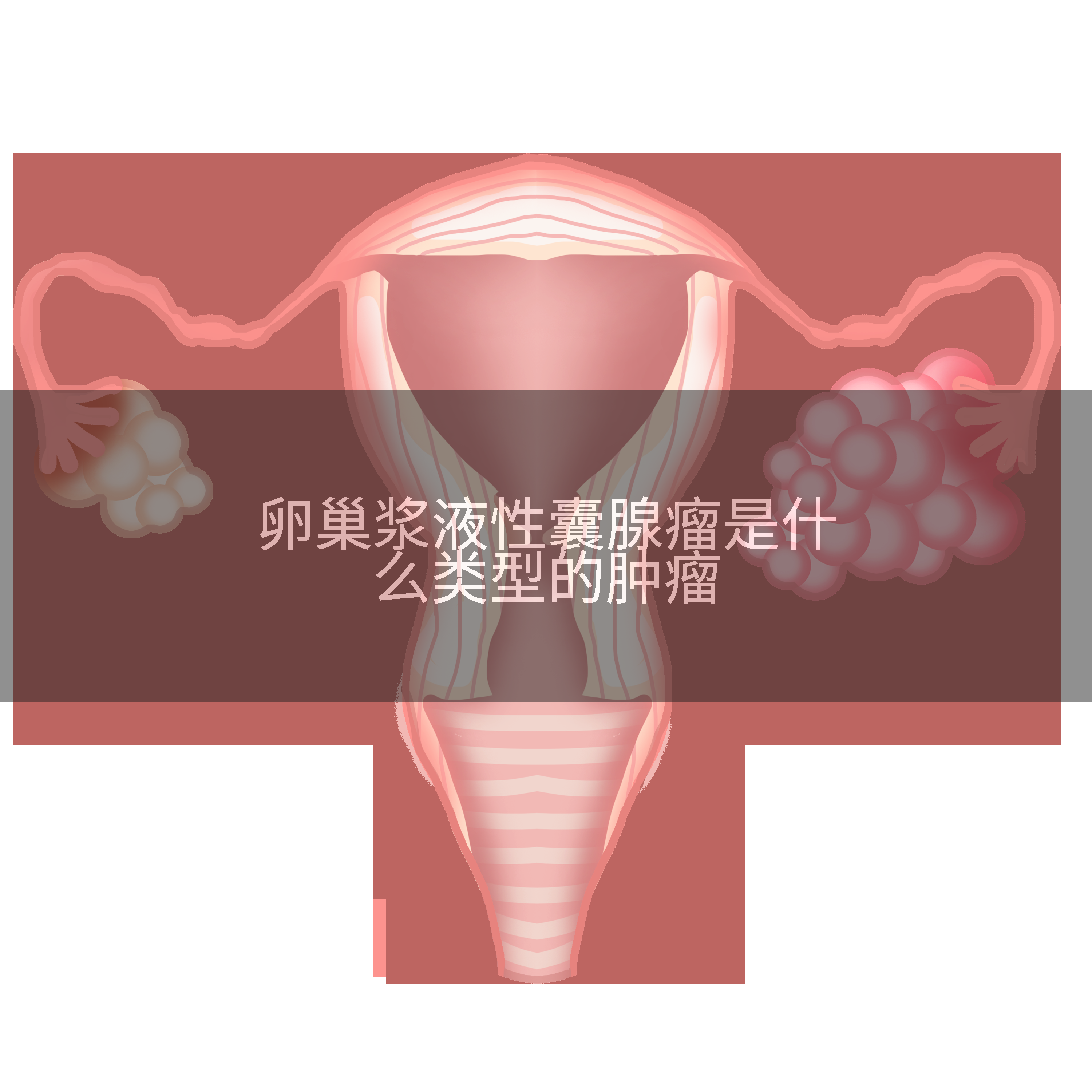 卵巢浆液性囊腺瘤是什么类型的肿瘤