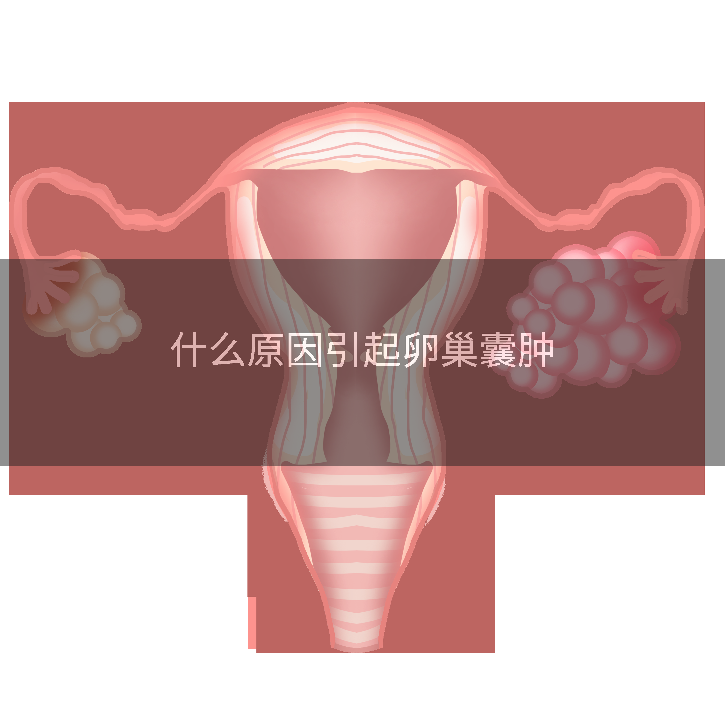 什么原因引起卵巢囊肿