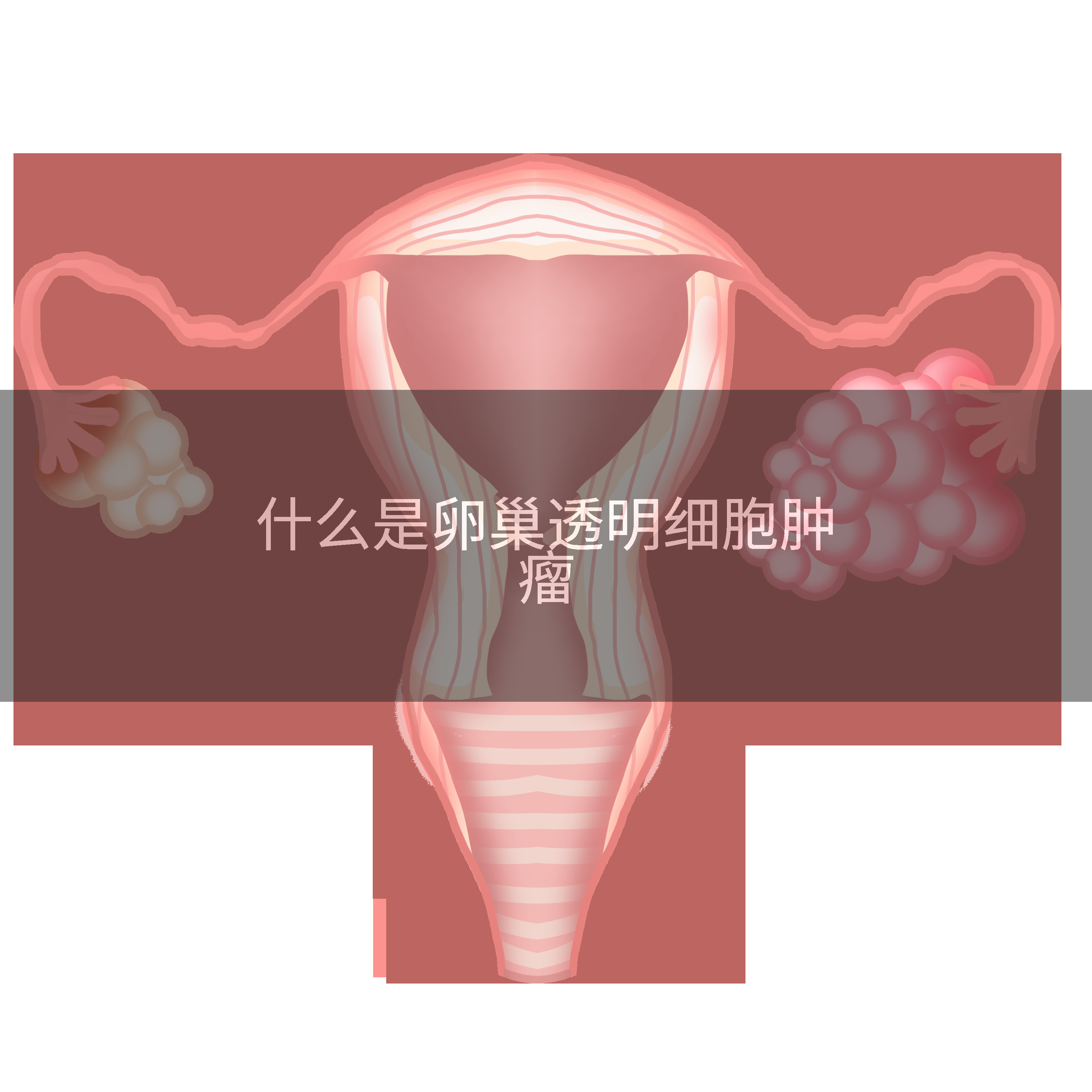 什么是卵巢透明细胞肿瘤